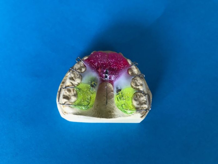 Farblich frei wählbare herausnehmbare Zahnspange, Kieferorthopädie Wörgl